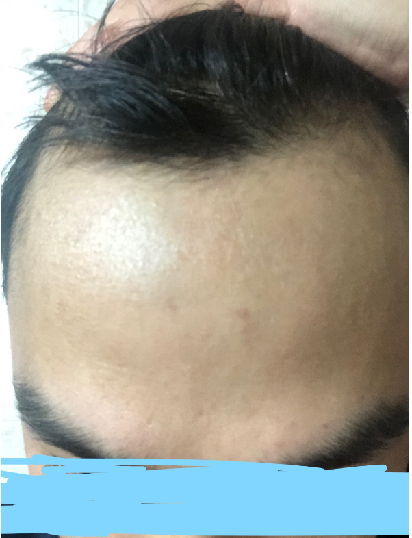 수술직후부터 다음날 이식샴푸까지 리얼수술후기