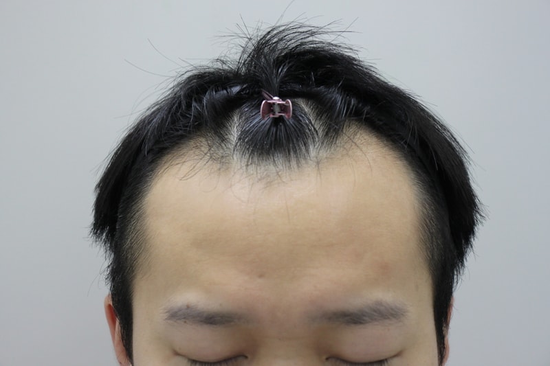 포헤어 서울점 비절개모발이식 1년 경과 감사합니다