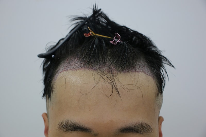 수술후 2.JPG
