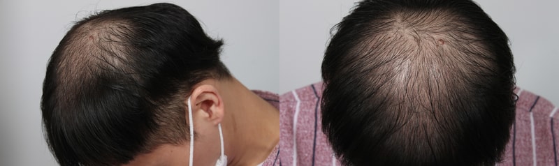 부산포헤어 1500모낭 5개월후기 밀도 어떤가요?