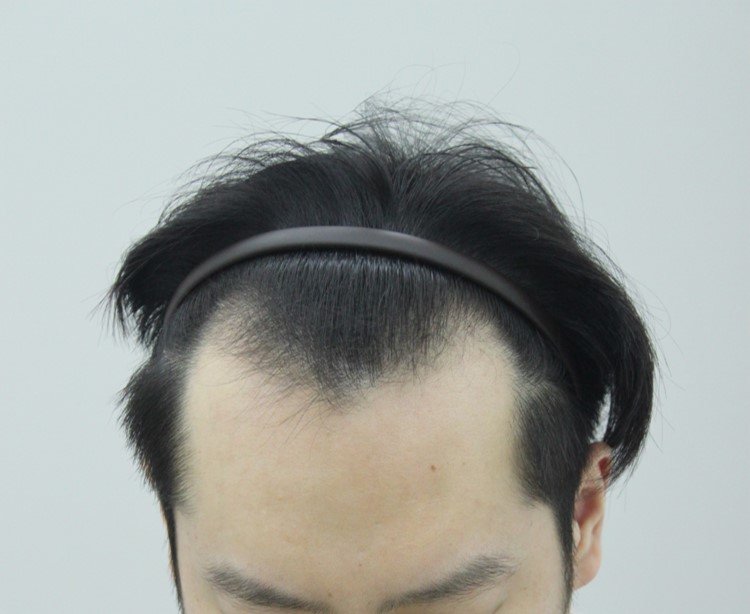 6개월 경과 어떤가요