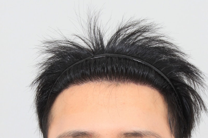 수술10개월.JPG