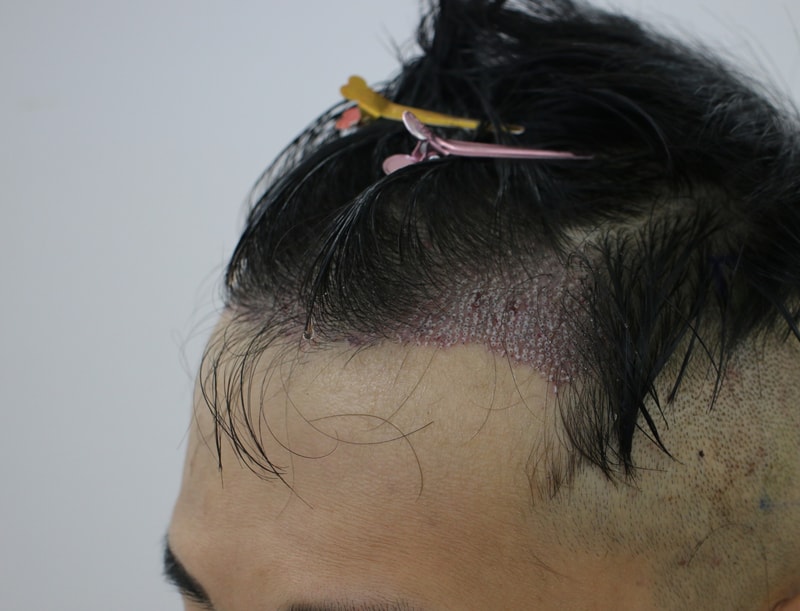수술후 3.JPG