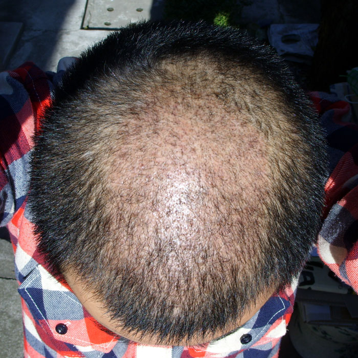 편집 수술후 22일.jpg