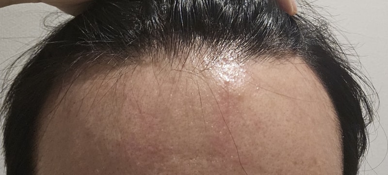 Incheon Maimo 1300 Hair follicle Hair Transplant Post-Day 2