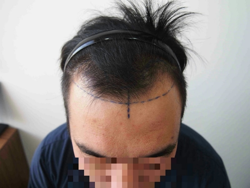 3월16일날 수술받고 22일 경과후 사진 몇장 올려봅니다.