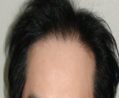 수술전 11.jpg
