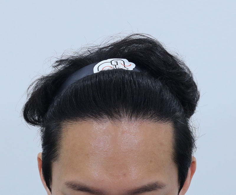 10개월 경과 / 지금 결단하지 않으면 있던 머리도 지킬 수 없습니다 / 사진有