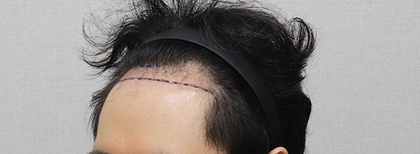2. 수술 전 디자인 IMG_2906.JPG