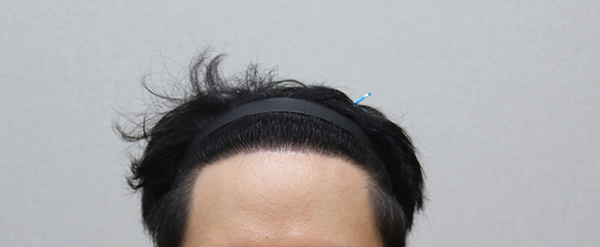 4. 1년 2개월 경과 IMG_5930.JPG