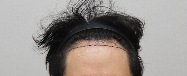 1. 수술 전 디자인 IMG_2903.JPG
