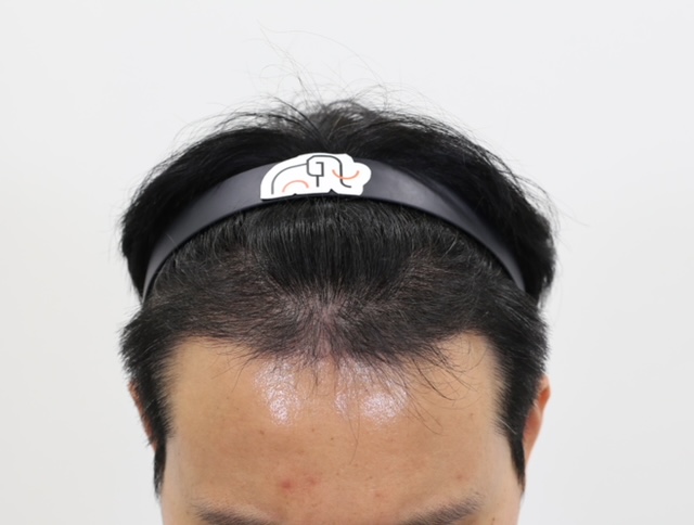 압구정 맘모스 헤어라인 남성M자 모발이식 4개월 후기