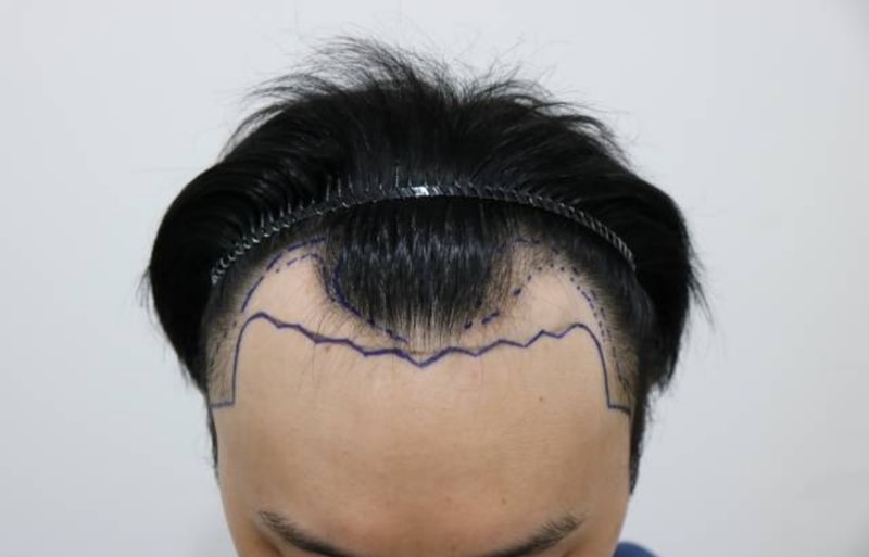 Non-cut (line-cut) M-shaped 3700 hair transplant month and later.