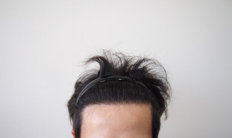 비절개 8개월차 후기