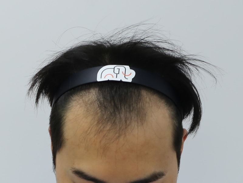 비절개 모발이식 1년 3개월 경과 후기(석지웅원장님)