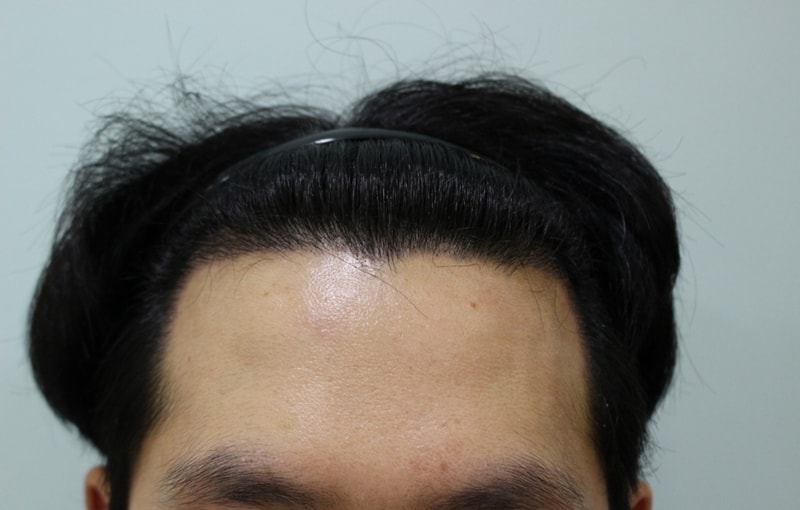 이식 딱지제거 후 정면.jpg