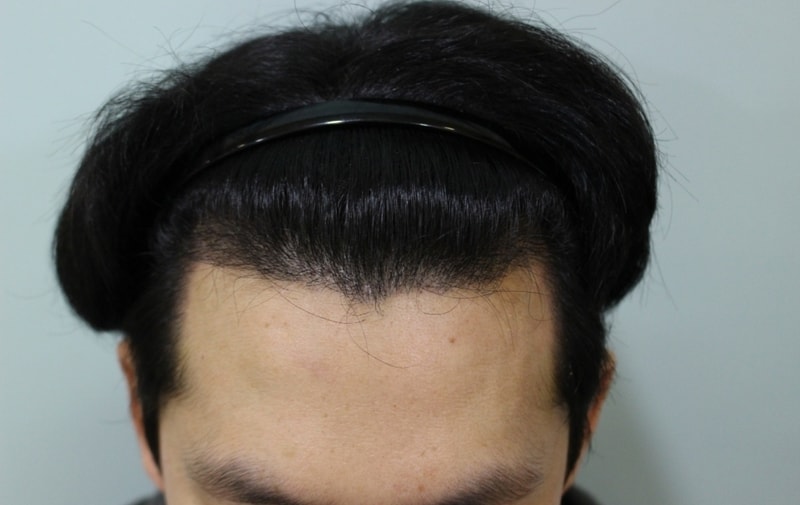 이식 딱지제거 후 정면 2.jpg