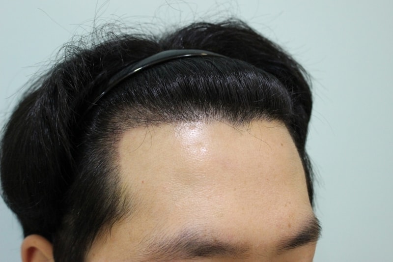 이식 딱지제거 후 우.jpg