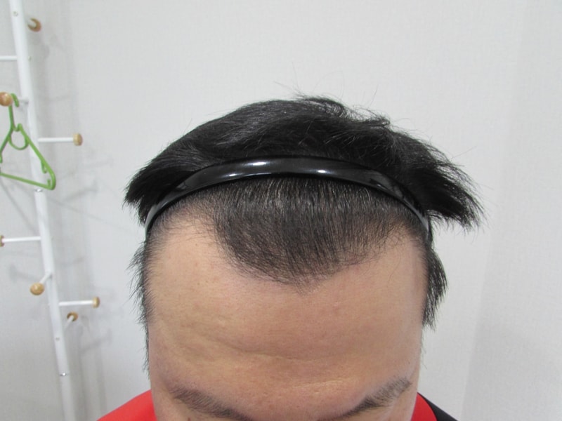 수술전.jpg