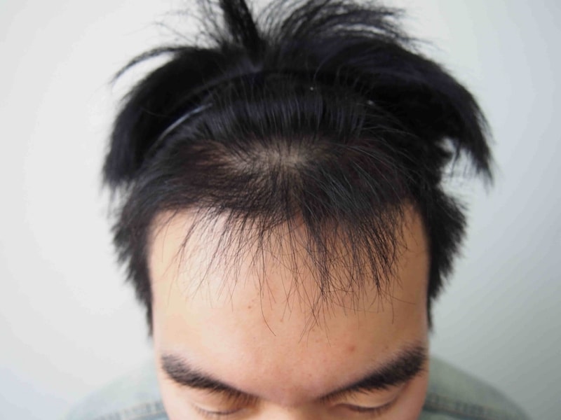 모재성 M자 탈모 4개월 후기입니다.