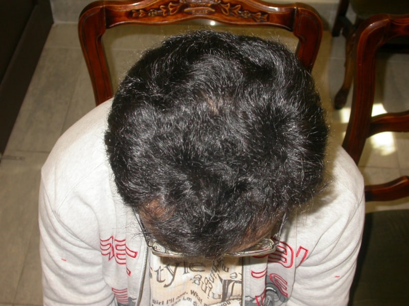 수술175일째 (정수리).jpg