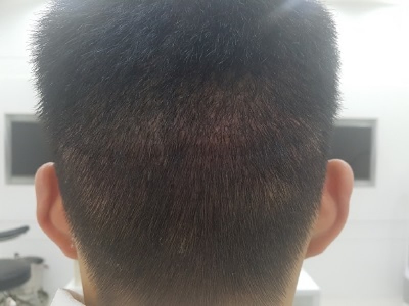 현재 후두부 상태 1.jpg