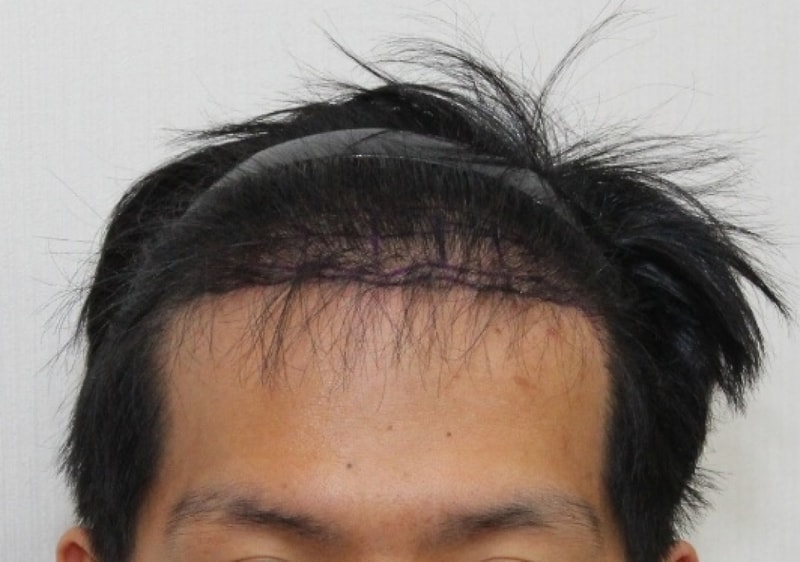 3차 수술 당일.png