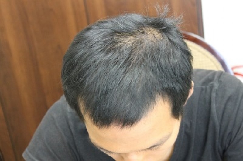 뉴헤어 1년 2개월 후기 (3차수술)