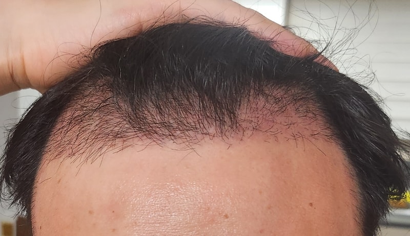 다나 비절개 4500모 이식 7주 후기