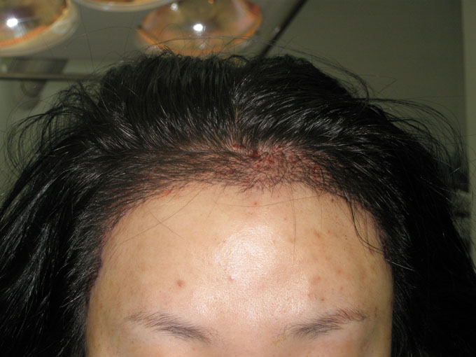 헤어라인2 004.jpg2.jpg