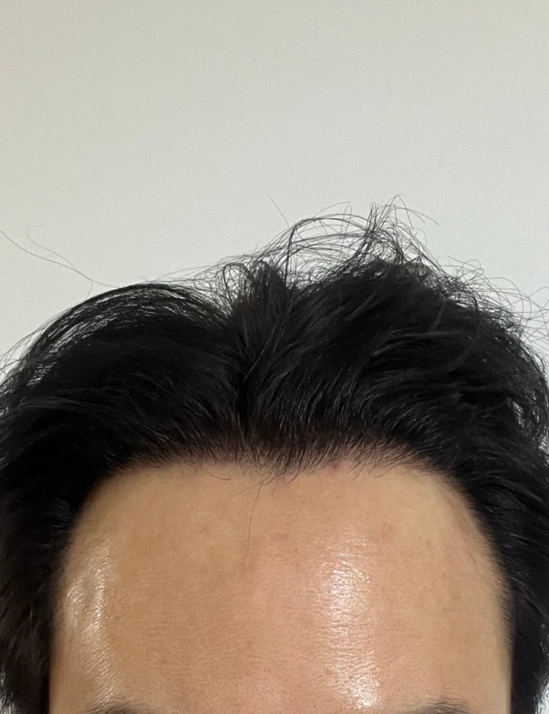 1.수술전1.jpg