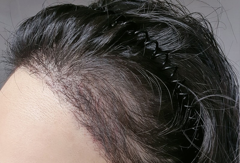 수술-후-21일-측면.jpg