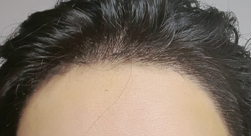 수술7일차_정면.jpg