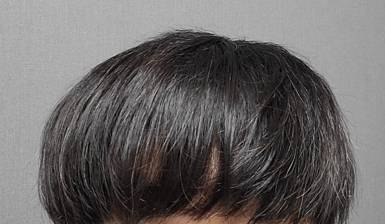 3.수술 1년 후2.jpg