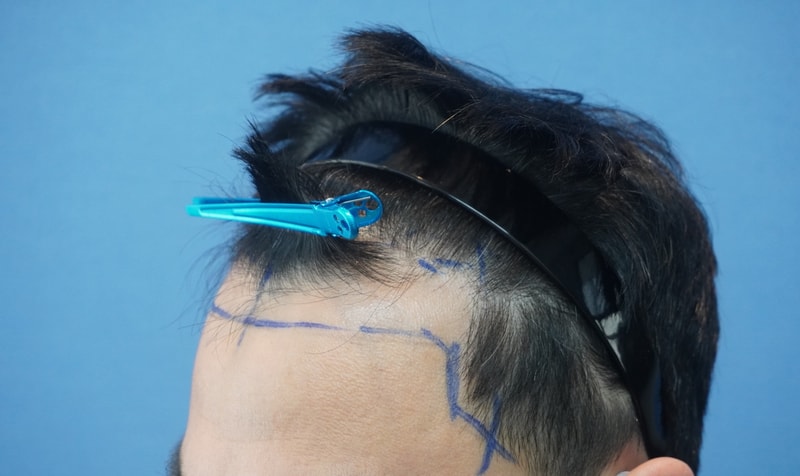 1.수술전4.JPG