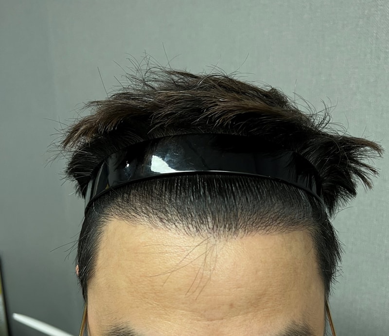 2.수술 1년후5.jpg