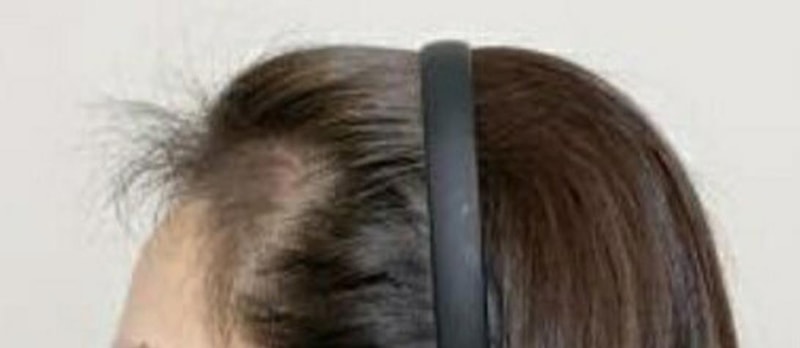 수술-후-3개월-측면.jpg