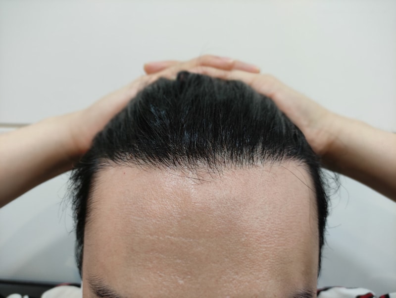 모재성 모발이식 수술 1년 후기입니다!