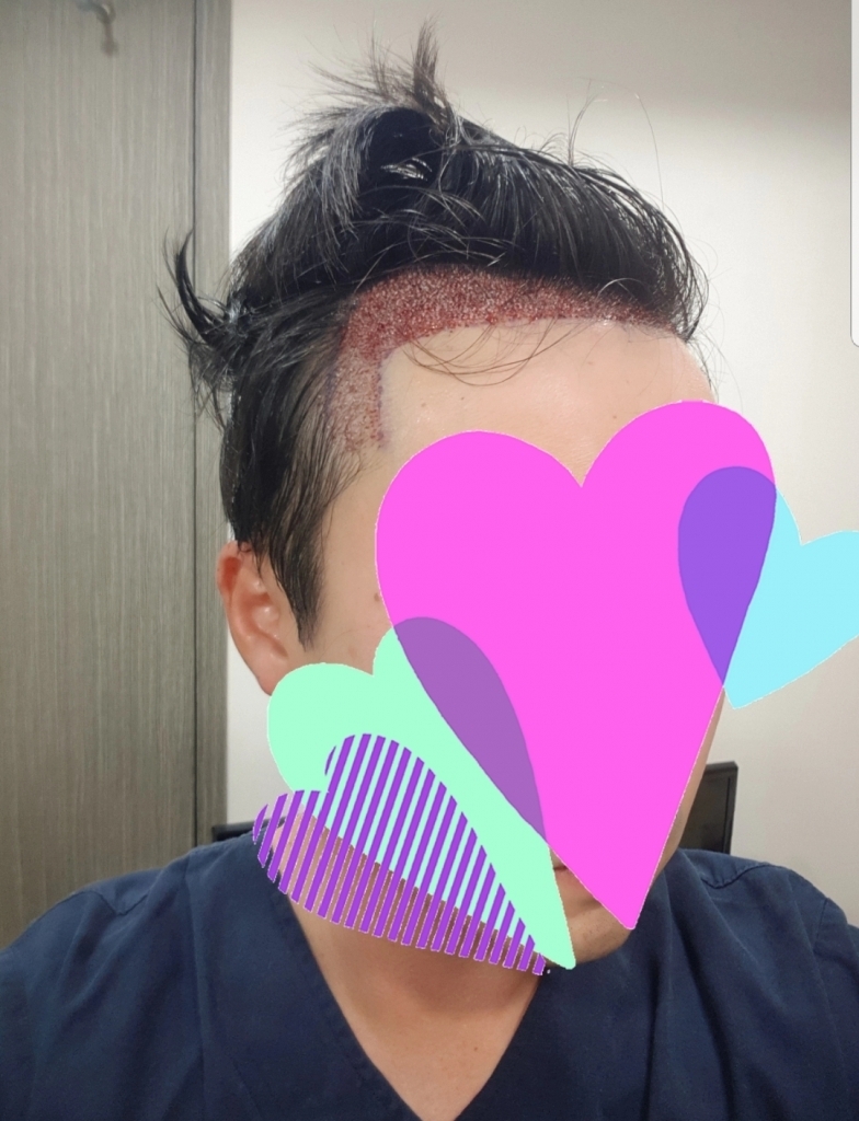 오늘 모발이식 했습니다.