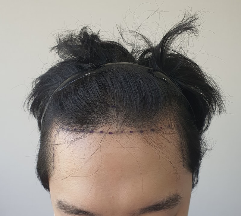 모재성 모발이식 당일 후기, 수술 과정 및 투블럭에 대해서 (비절개, 투블럭) - 3줄 요약 있음
