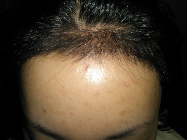 헤어라인2 009.jpg