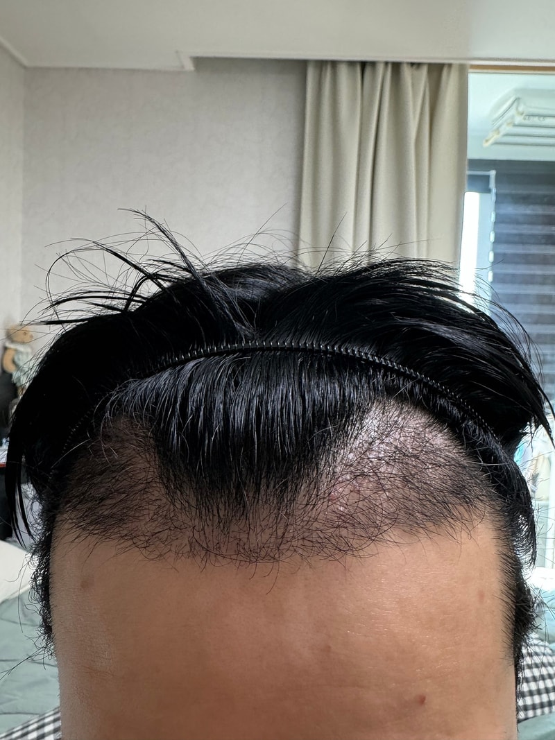 그로우의원 비절개 3000모 모발이식 3개월차 후기