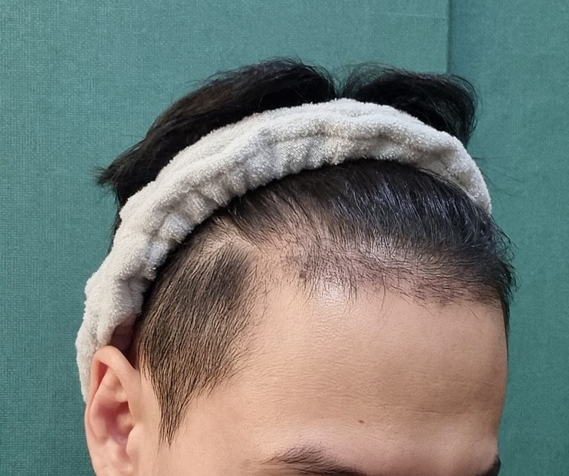 그로우의원(구 뉴헤어부산)에서 비절개로 이식한지 한달째입니다