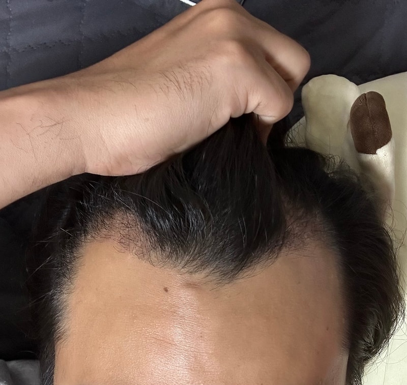 그로우의원(구 뉴헤어부산) 모발이식 2100모 1개월차