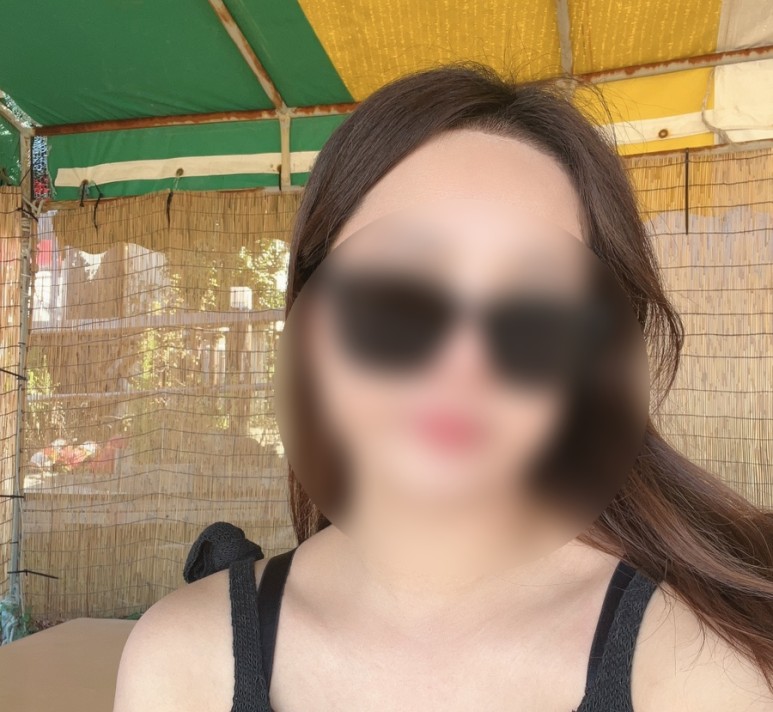 그로우의원(구 뉴헤어부산)뉴헤어모발성형외과에서 헤어라인 수술 한달 차 후기