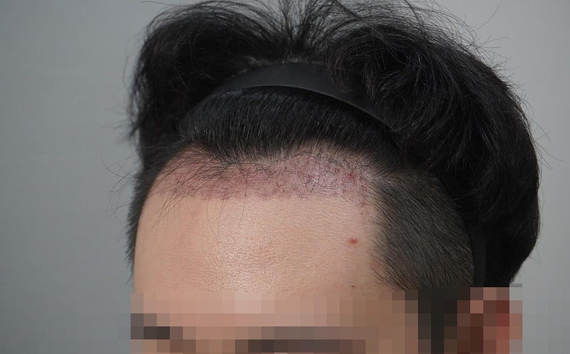 그로우의원(구 뉴헤어부산) 모발 이식 1개월경과 후기