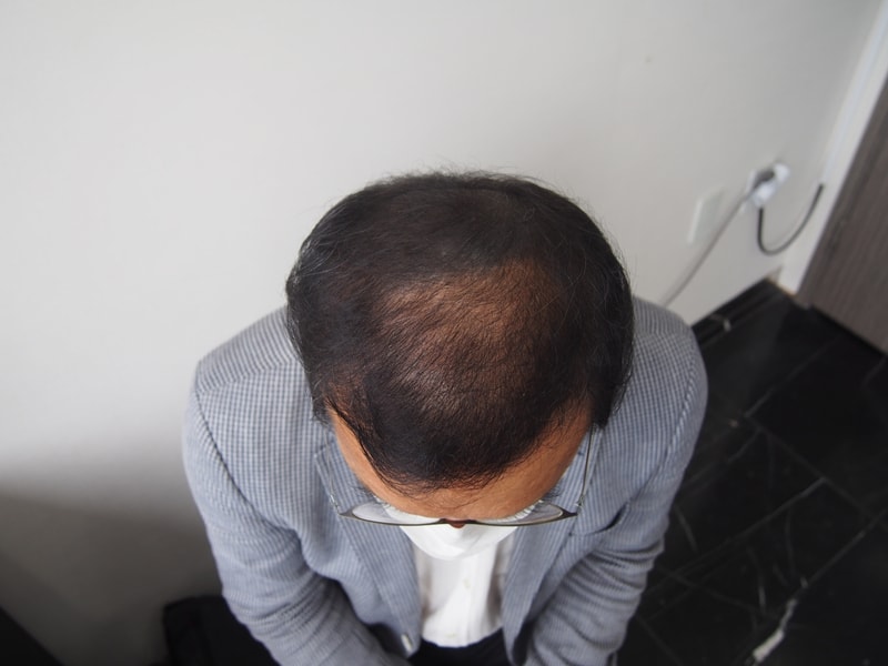 모재성 모발이식센터:모발 이식 4개월 경과