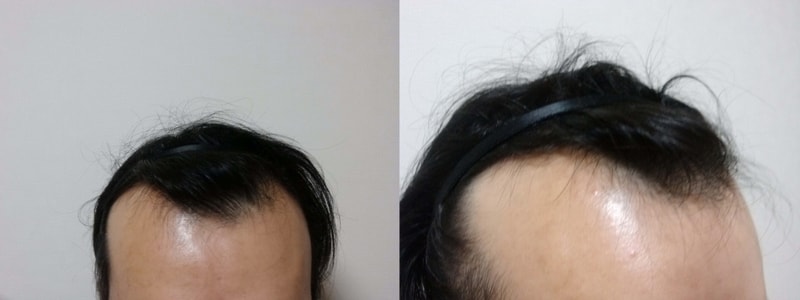 수술전 심한 M자와 좌우비대칭.jpg