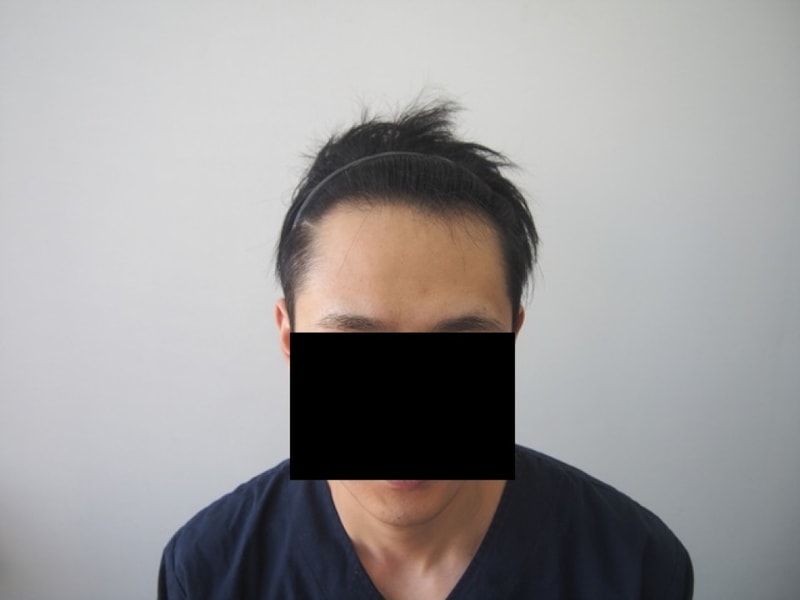 1300모낭 비절개 8개월 후기입니다.