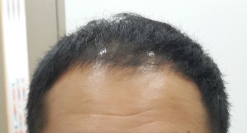 수술전 정면 .jpg